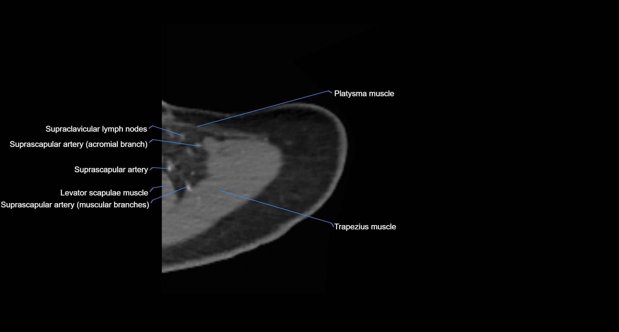 CT Shoulder axial cross sectional anatomy labelled radiology image -00008.webp